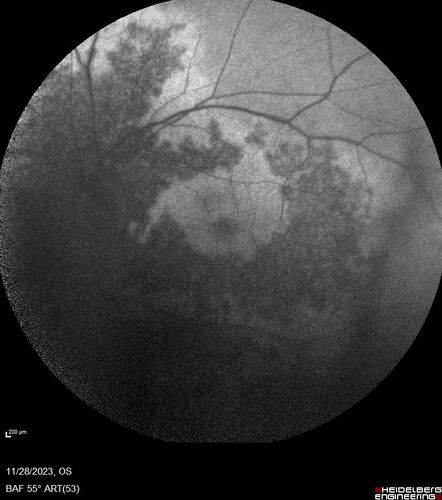 AZOOR - Inactive
Sudden vision loss in the left eye 3 years ago.  Labs for syphilis, sarcoid and TB all negative.  VA 20/32 OD, 20/80 OS
