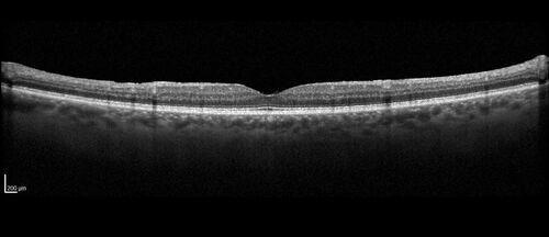 AZOOR - Inactive
Sudden vision loss in the left eye 3 years ago.  Labs for syphilis, sarcoid and TB all negative.  VA 20/32 OD, 20/80 OS
