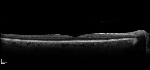 AZOOR - Inactive
Sudden vision loss in the left eye 3 years ago.  Labs for syphilis, sarcoid and TB all negative.  VA 20/32 OD, 20/80 OS
