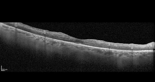 AZOOR - Inactive
Sudden vision loss in the left eye 3 years ago.  Labs for syphilis, sarcoid and TB all negative.  VA 20/32 OD, 20/80 OS
