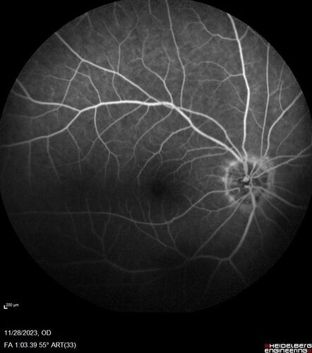 AZOOR - Inactive
Sudden vision loss in the left eye 3 years ago.  Labs for syphilis, sarcoid and TB all negative.  VA 20/32 OD, 20/80 OS
