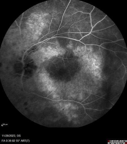 AZOOR - Inactive
Sudden vision loss in the left eye 3 years ago.  Labs for syphilis, sarcoid and TB all negative.  VA 20/32 OD, 20/80 OS
