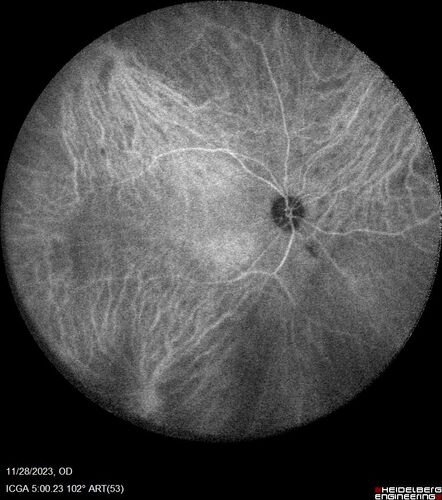 AZOOR - Inactive
Sudden vision loss in the left eye 3 years ago.  Labs for syphilis, sarcoid and TB all negative.  VA 20/32 OD, 20/80 OS
