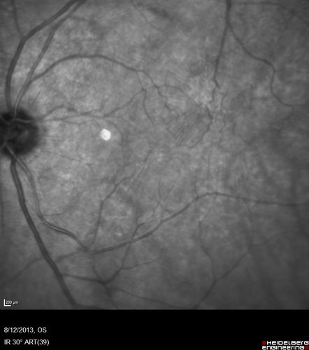 Vitreomacular Traction -> Macular Hole -> Aborted Macular hole
Progression of VMT in both eyes over time
