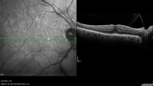 Vitreomacular Traction -> Macular Hole -> Aborted Macular hole
Progression of VMT in both eyes over time
