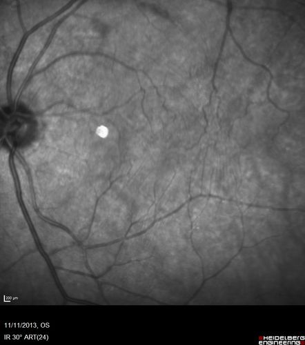 Vitreomacular Traction -> Macular Hole -> Aborted Macular hole
Progression of VMT in both eyes over time

