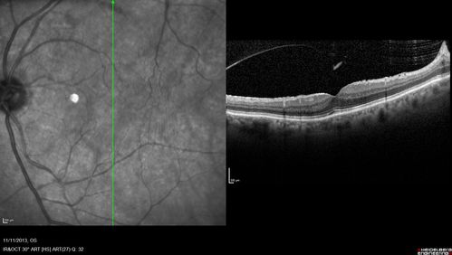 Macular Hole Left Eye - progression from VMT - Stage II macular hole - Spontaneously Closed Macular Hole
Vision better left eye VMT has released the fovea (was 20/25)
