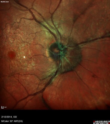 Vitreomacular Traction -> Macular Hole -> Aborted Macular hole
Progression of VMT in both eyes over time
