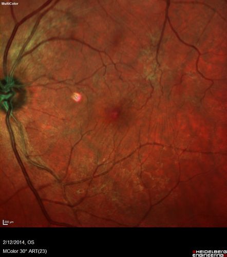 Vitreomacular Traction -> Macular Hole -> Aborted Macular hole
Progression of VMT in both eyes over time
