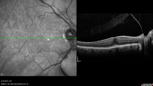 Macular Hole Left Eye - progression from VMT - Stage II macular hole - Spontaneously Closed Macular Hole
