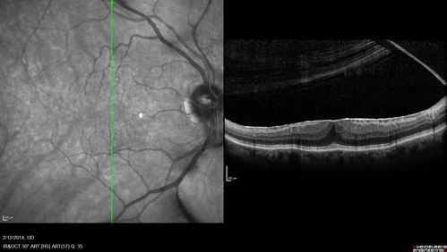 Vitreomacular Traction -> Macular Hole -> Aborted Macular hole
Progression of VMT in both eyes over time
