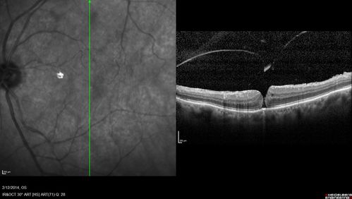 Vitreomacular Traction -> Macular Hole -> Aborted Macular hole
Progression of VMT in both eyes over time
