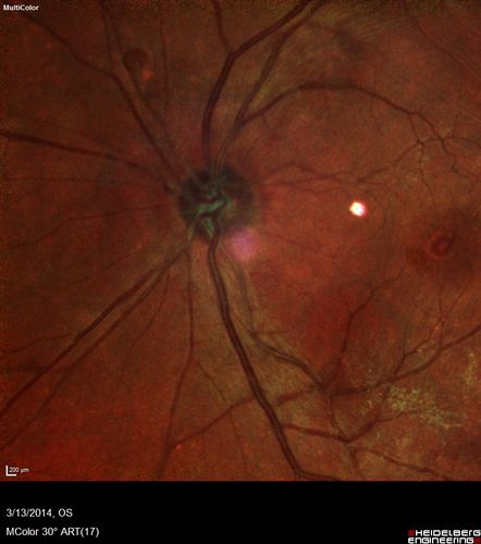 Macular Hole Left Eye - progression from VMT - Stage II macular hole - Spontaneously Closed Macular Hole
