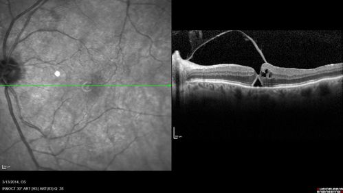 Macular Hole Left Eye - progression from VMT - Stage II macular hole - Spontaneously Closed Macular Hole
