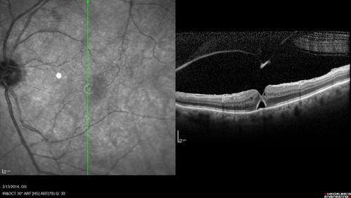 Macular Hole Left Eye - progression from VMT - Stage II macular hole - Spontaneously Closed Macular Hole
Macular hole is closing and vision has improved to 20/40
