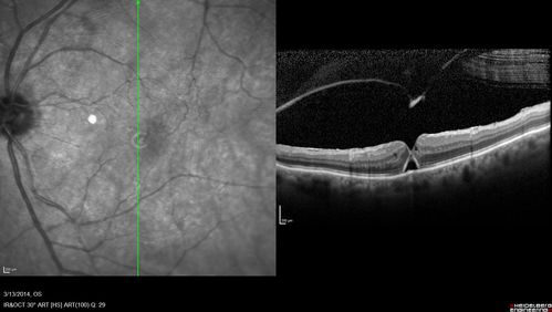 Vitreomacular Traction -> Macular Hole -> Aborted Macular hole
Progression of VMT in both eyes over time
