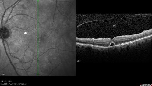 Vitreomacular Traction -> Macular Hole -> Aborted Macular hole
Progression of VMT in both eyes over time
