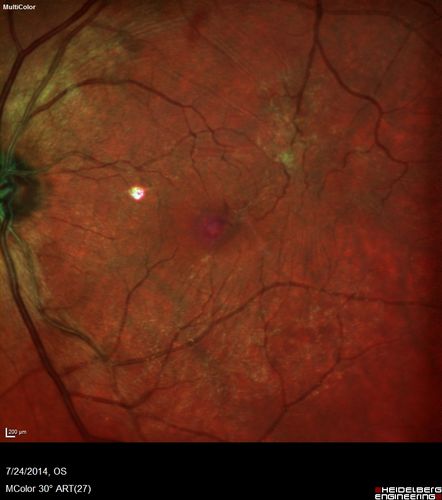 Vitreomacular Traction -> Macular Hole -> Aborted Macular hole
Progression of VMT in both eyes over time
