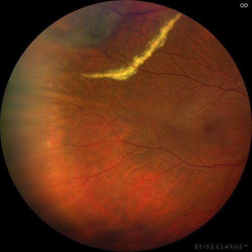 Retinal Angioma
53 year old female with no-symptoms and no significant medical history (or family history)
