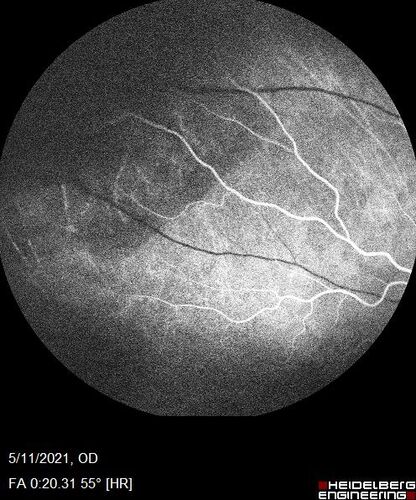 Retinal Angioma
53 year old female with no-symptoms and no significant medical history (or family history)
