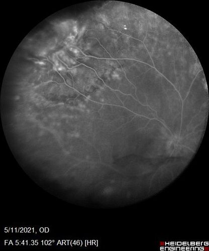 Retinal Angioma
53 year old female with no-symptoms and no significant medical history (or family history)
