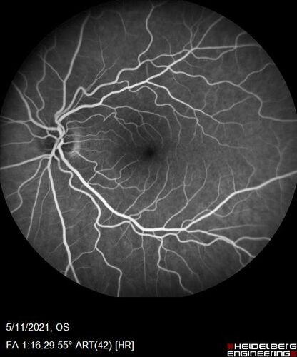 Retinal Angioma
53 year old female with no-symptoms and no significant medical history (or family history)

