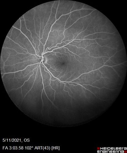 Retinal Angioma
53 year old female with no-symptoms and no significant medical history (or family history)
