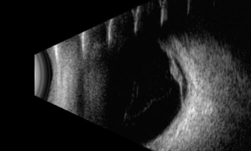 Retinal Angioma
53 year old female with no-symptoms and no significant medical history (or family history)
