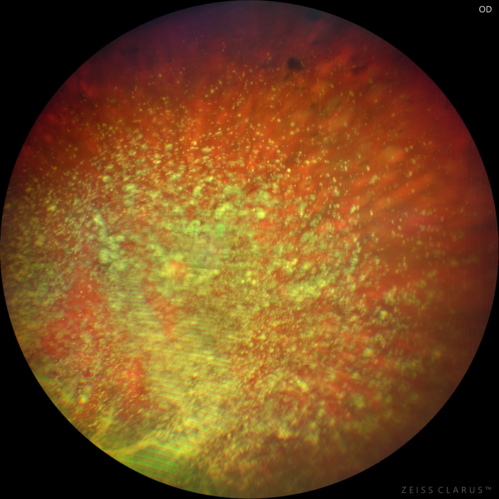 Asteroid Hyalosis -  Clarus Color Image
