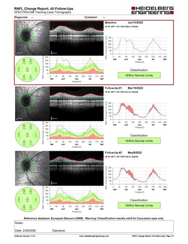 Optic Disc Drusen in a child (non Calcified)
Fluorescein angiography shows no leakage
