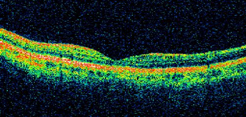 Occult Maculopathy - Thin Fovea on OCT and Normal Color VA, Photos, FA VA 20/80 OU
45-year-old man his mother and his maternal grandmother each had vision loss at a relatively young age.  LINE SCAN SHOW FOVEAL ATROPHY
