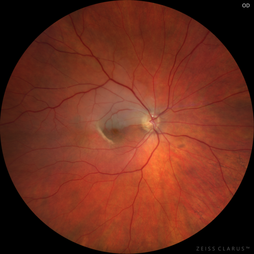 Acute Branch Retinal Arteriolar Occlusion
75 year old female treated for wet AMD with 2 days of inferior shadow in the right eye.  VA 20/40.  There is a plaque visible and retinal whitening from the arteriolar occlusion.

