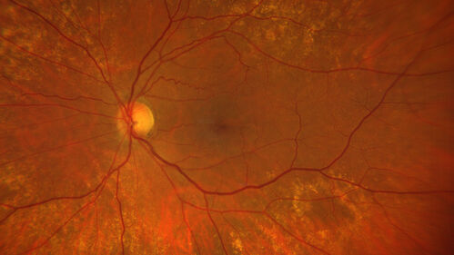 BRAO - plaques in vessels - GIF video of FA
78 year old female with vision loss for 1 week and old macular scar.  Images show BRAO with plaques and FA shows occlusion.
