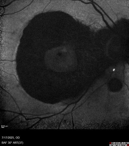 BRAO - plaques in vessels - GIF video of FA
78 year old female with vision loss for 1 week and old macular scar.  Images show BRAO with plaques and FA shows occlusion.
