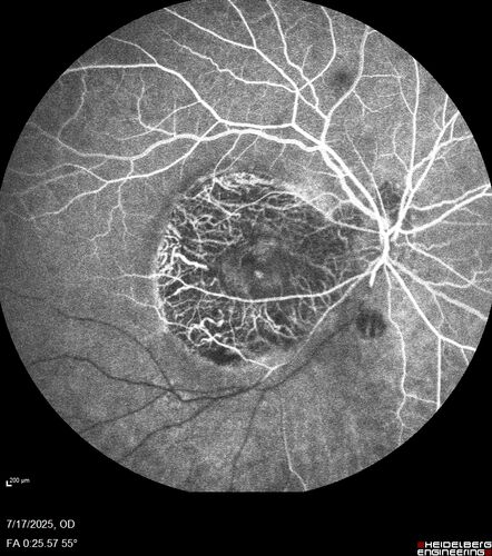 BRAO - plaques in vessels - GIF video of FA
78 year old female with vision loss for 1 week and old macular scar.  Images show BRAO with plaques and FA shows occlusion.
