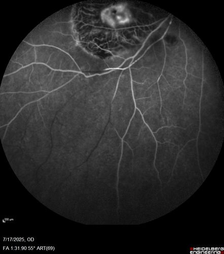 BRAO - plaques in vessels - GIF video of FA
78 year old female with vision loss for 1 week and old macular scar.  Images show BRAO with plaques and FA shows occlusion.
