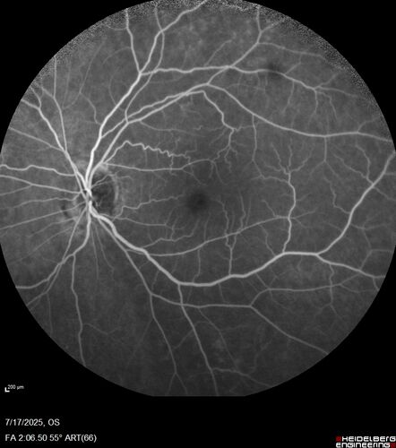 BRAO - plaques in vessels - GIF video of FA
78 year old female with vision loss for 1 week and old macular scar.  Images show BRAO with plaques and FA shows occlusion.
