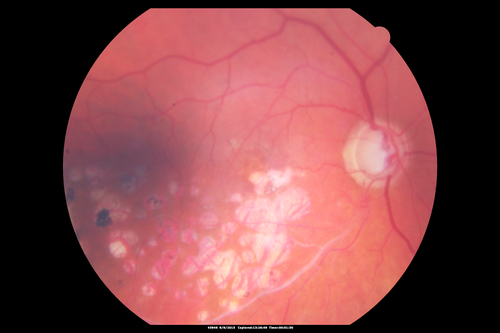 Acute Branch Retinal Artery Occlusion Left Eye
This 84 year old woman had an old BRVO in the right eye and saw a shadow for 2 days in the left eye.  She has a superotemporal BRAO.  The photos show retinal whitening, the OCT shows inner retinal edema and the FA shows poor circulation.
