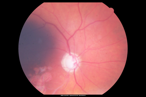 Acute Branch Retinal Artery Occlusion Left Eye
This 84 year old woman had an old BRVO in the right eye and saw a shadow for 2 days in the left eye.  She has a superotemporal BRAO.  The photos show retinal whitening, the OCT shows inner retinal edema and the FA shows poor circulation.
