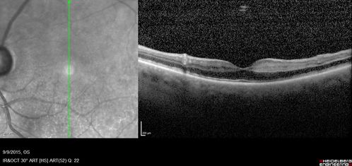 Acute Branch Retinal Artery Occlusion Left Eye
This 84 year old woman had an old BRVO in the right eye and saw a shadow for 2 days in the left eye.  She has a superotemporal BRAO.  The photos show retinal whitening, the OCT shows inner retinal edema and the FA shows poor circulation.

