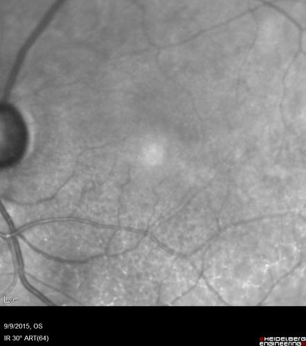 Acute Branch Retinal Artery Occlusion Left Eye
This 84 year old woman had an old BRVO in the right eye and saw a shadow for 2 days in the left eye.  She has a superotemporal BRAO.  The photos show retinal whitening, the OCT shows inner retinal edema and the FA shows poor circulation.
