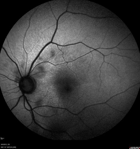 Acute Branch Retinal Artery Occlusion Left Eye
This 84 year old woman had an old BRVO in the right eye and saw a shadow for 2 days in the left eye.  She has a superotemporal BRAO.  The photos show retinal whitening, the OCT shows inner retinal edema and the FA shows poor circulation.
