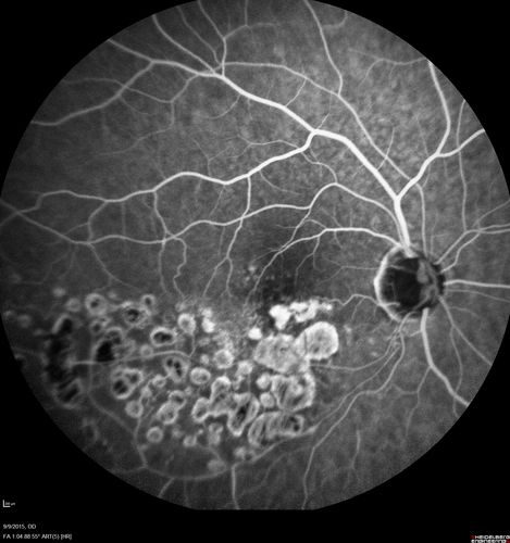 Acute Branch Retinal Artery Occlusion Left Eye
This 84 year old woman had an old BRVO in the right eye and saw a shadow for 2 days in the left eye.  She has a superotemporal BRAO.  The photos show retinal whitening, the OCT shows inner retinal edema and the FA shows poor circulation.
