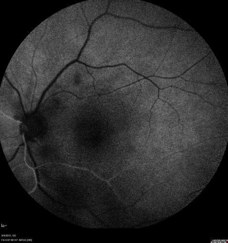 Acute Branch Retinal Artery Occlusion Left Eye
This 84 year old woman had an old BRVO in the right eye and saw a shadow for 2 days in the left eye.  She has a superotemporal BRAO.  The photos show retinal whitening, the OCT shows inner retinal edema and the FA shows poor circulation.
