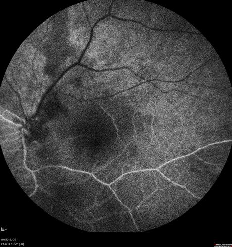 Acute Branch Retinal Artery Occlusion Left Eye
This 84 year old woman had an old BRVO in the right eye and saw a shadow for 2 days in the left eye.  She has a superotemporal BRAO.  The photos show retinal whitening, the OCT shows inner retinal edema and the FA shows poor circulation.
