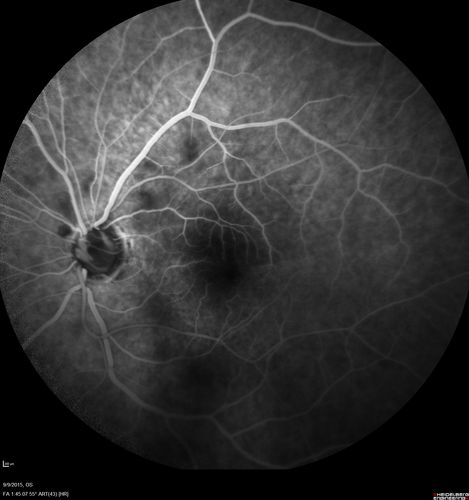 Acute Branch Retinal Artery Occlusion Left Eye
This 84 year old woman had an old BRVO in the right eye and saw a shadow for 2 days in the left eye.  She has a superotemporal BRAO.  The photos show retinal whitening, the OCT shows inner retinal edema and the FA shows poor circulation.

