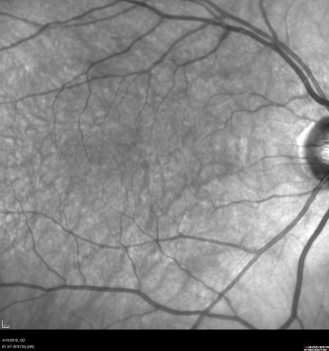 Subtle Branch Retinal Artery Occlusion
68 year old man with shadow in the left eye yesterday.  IR and OCT show subtle retinal swelling.  FA is normal
