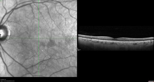 Subtle Branch Retinal Artery Occlusion
68 year old man with shadow in the left eye yesterday.  IR and OCT show subtle retinal swelling.  FA is normal
