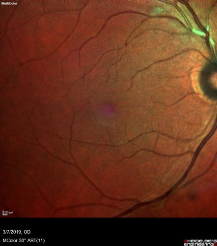 Branch Retinal Vein Occlusion with Edema - Failed avastin (bevacizumab) and did well with Eylea (Aflibercept)
67 year old female The vision in the left eye was good until about 4 months ago.Â  Prior to that it was OK.Â  The vision in the right eye is fine.Â  She is not sure if she has had strokes from studies taken in December.Â  She was, at that time, sent to the ER for high blood pressure.Â Â 
VA OD: Dcc20/40 OS: 20/100
Four treatments with Avastin she was still 20/100 with edema.  With two Eylea treatments she improved to 20/32 and has remained dry and with good vision

