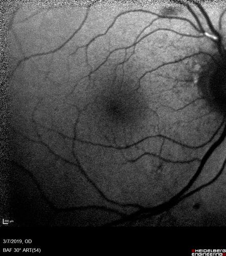 Branch Retinal Vein Occlusion with Edema - Failed avastin (bevacizumab) and did well with Eylea (Aflibercept)
67 year old female The vision in the left eye was good until about 4 months ago.Â  Prior to that it was OK.Â  The vision in the right eye is fine.Â  She is not sure if she has had strokes from studies taken in December.Â  She was, at that time, sent to the ER for high blood pressure.Â Â 
VA OD: Dcc20/40 OS: 20/100
Four treatments with Avastin she was still 20/100 with edema.  With two Eylea treatments she improved to 20/32 and has remained dry and with good vision
